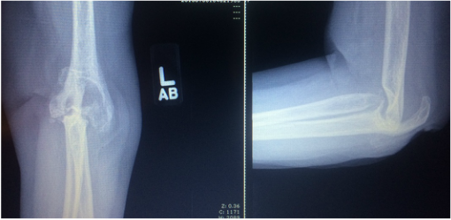 Rheumatoid elbow arthritis