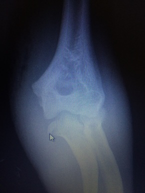 elbow fracture dislocation