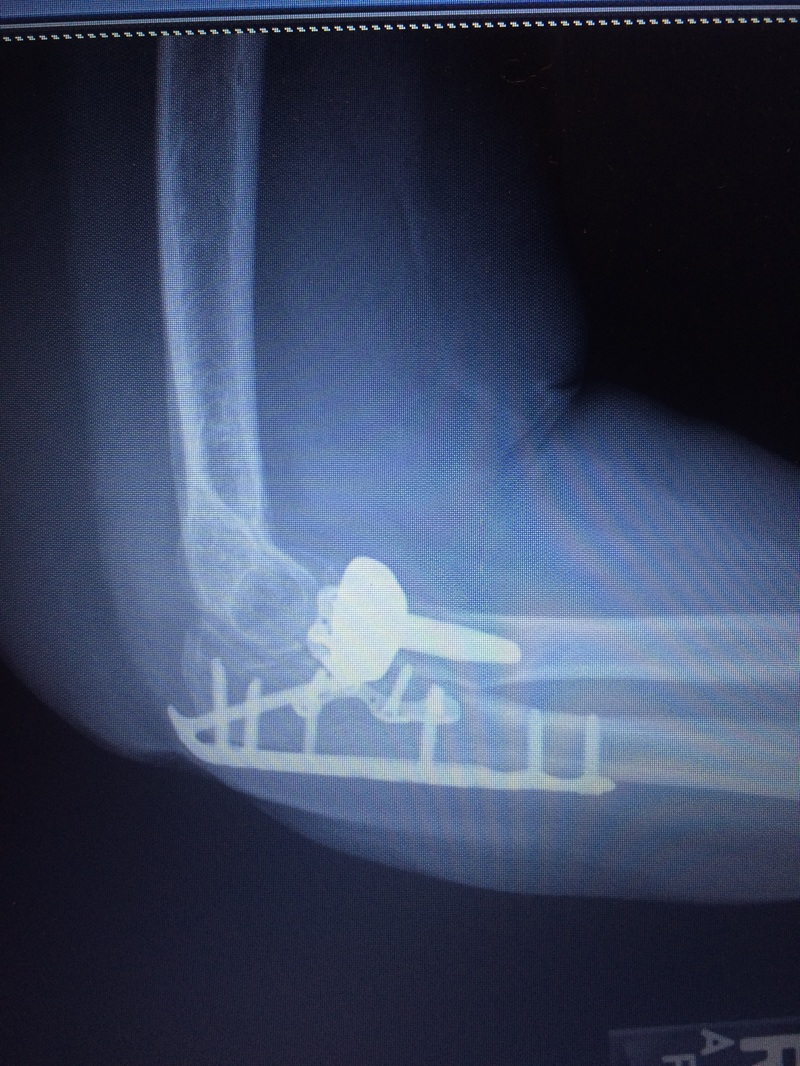 elbow fracture/dislocation